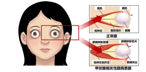 眼突如金鱼还有救吗？眼科专家解读“金鱼眼”的病因和治疗方法！