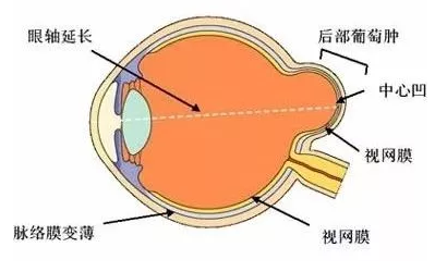 为了让高度近视的脚步慢下来，我选择“绑紧”孩子的眼球