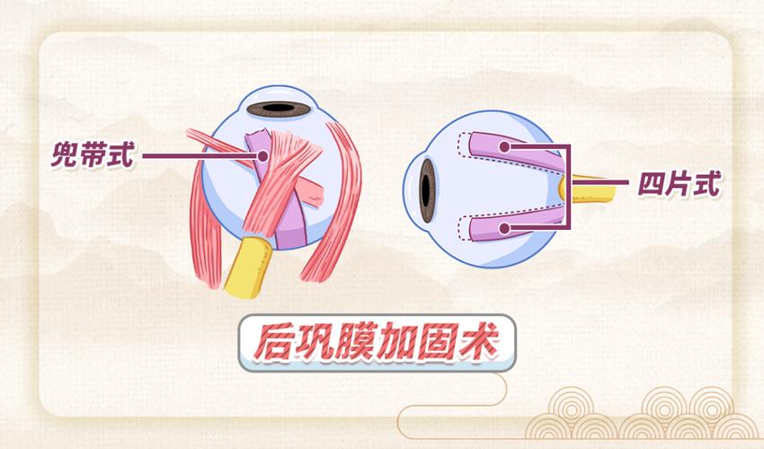 为了让高度近视的脚步慢下来，我选择“绑紧”孩子的眼球