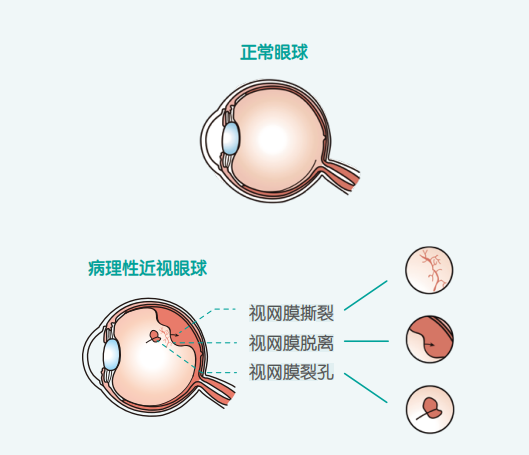 为了让高度近视的脚步慢下来，我选择“绑紧”孩子的眼球